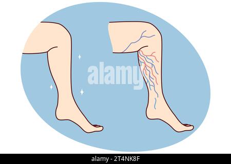 Primo piano della gamba sana e malsana con vene varicose. Il paziente soffre di varicosi. Sanità e medicina. Illustrazione vettoriale. Illustrazione Vettoriale