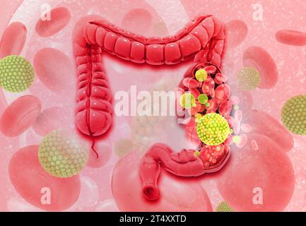 Cancro al colon. Cellule virali sul colon. illustrazione 3d. Foto Stock