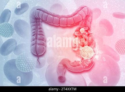 Cancro al colon. Cellule virali sul colon. illustrazione 3d. Foto Stock