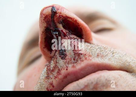 Sanguinoso naso di un uomo anziano Foto Stock