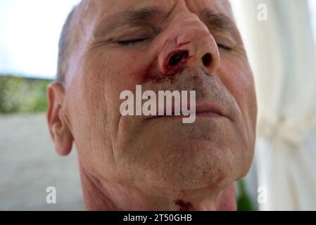 Sanguinoso naso di un uomo anziano Foto Stock