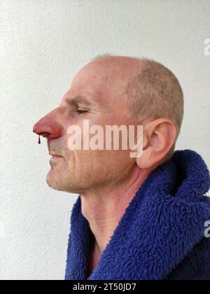 Sanguinoso naso di un uomo anziano Foto Stock