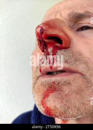 Sanguinoso naso di un uomo anziano Foto Stock