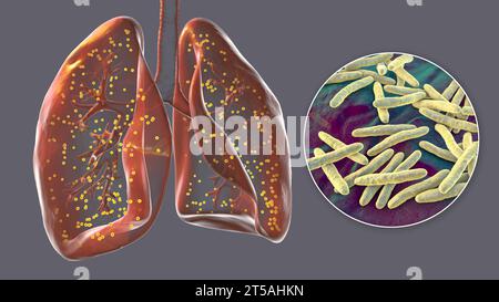 Polmoni affetti da tubercolosi miliare, illustrazione Foto Stock