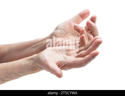 Mani di una donna anziana con la contrattura di Dupuytren Foto Stock