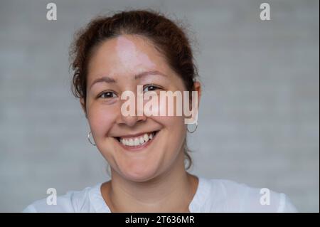 Ragazza sorridente con una malattia autoimmune che colpisce la pelle. Ritratto di una donna con macchie pigmentate di vitiligine sulla fronte. Foto Stock