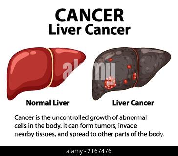 Infografica che illustra le differenze tra cellule epatiche sane e cancerose Illustrazione Vettoriale