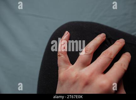 Foto ravvicinata di peperoncino sulla mano di Fingers Girl con il fenomeno di Raynaud e lesioni infantili sulle dita Perniosi dita gonfie rosse Foto Stock