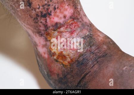 Closeup delle gambe di una donna che soffre di psoriasi cronica su uno sfondo bianco. Closeup di eruzione cutanea e scalatura sulla pelle del paziente. Dermatologico Foto Stock