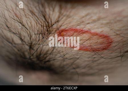 Primo piano dettagliato di infezione fungina tigna (tinea) sulla pelle umana – immagine ad alta risoluzione che raffigura il distintivo rosso, eruzione circolare e scalare comune alla dermatofitosi; utile per medico, Dermatologia, e salute scopi di educazione per illustrare condizioni della pelle, sintomi, cause, prevenzione, e opzioni di trattamento per la tigna e altre infezioni fungine. Foto Stock