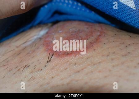 Primo piano dettagliato di infezione fungina tigna (tinea) sulla pelle umana – immagine ad alta risoluzione che raffigura il distintivo rosso, eruzione circolare e scalare comune alla dermatofitosi; utile per medico, Dermatologia, e salute scopi di educazione per illustrare condizioni della pelle, sintomi, cause, prevenzione, e opzioni di trattamento per la tigna e altre infezioni fungine. Foto Stock