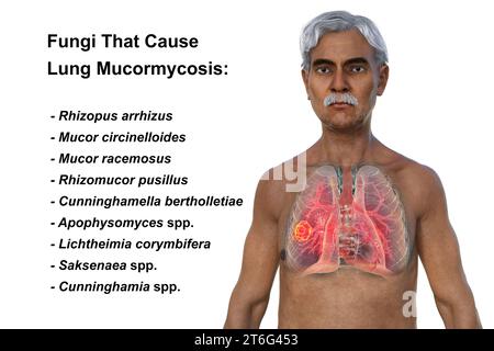 Illustrazione fotorealistica 3D della metà superiore di un uomo anziano con pelle trasparente, che rivela una lesione della mucormicosi polmonare. Foto Stock
