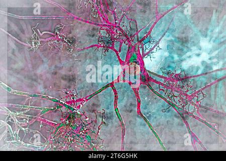 Neuroni in demenza. Malattia di Alzheimer, malattia di Huntington. Placche amiloidi nel tessuto cerebrale, grovigli neurofibrillari e diostruzione di n neuronale Foto Stock