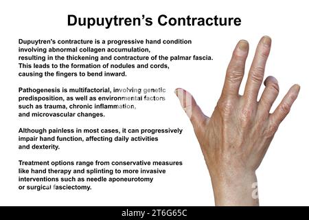 Mano di un paziente con contrattura di Dupuytren, una condizione che provoca la piegatura delle dita verso il palmo, illustrazione 3D fotorealistica Foto Stock