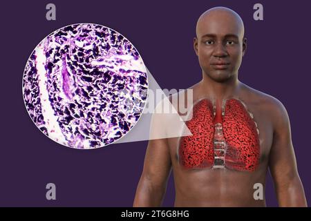 Un'illustrazione fotorealistica 3D della metà superiore di un uomo africano con pelle trasparente, rivelando le condizioni dei polmoni del fumatore, insieme a. Foto Stock