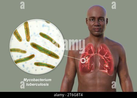 Un'illustrazione fotorealistica 3D della metà superiore di un uomo con pelle trasparente, che mostra i polmoni affetti da tubercolosi cavernosa, e Foto Stock