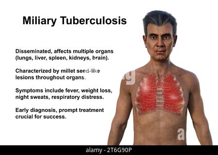 Un'illustrazione fotorealistica 3D che mostra la metà superiore di un uomo indiano con pelle trasparente, rivelando i polmoni colpiti da tubercolosi miliare Foto Stock