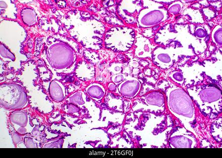 Micrografia dell'iperplasia prostatica, che mostra un aumento del tessuto ghiandolare. Foto Stock