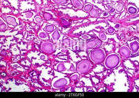 Micrografia dell'iperplasia prostatica, che mostra un aumento del tessuto ghiandolare. Foto Stock