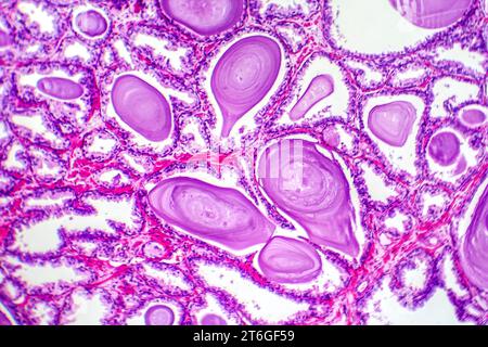 Micrografia dell'iperplasia prostatica, che mostra un aumento del tessuto ghiandolare. Foto Stock