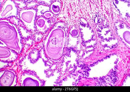 Micrografia dell'iperplasia prostatica, che mostra un aumento del tessuto ghiandolare. Foto Stock