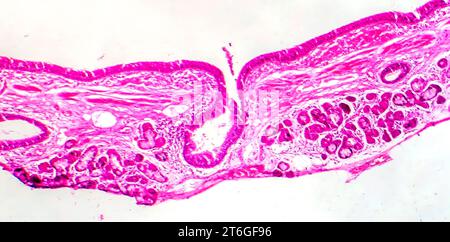 Fotomicrografia della metaplasia squamosa epiteliale bronchiale, che mostra la trasformazione delle cellule squamose nel rivestimento respiratorio. Foto Stock