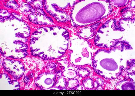 Micrografia dell'iperplasia prostatica, che mostra un aumento del tessuto ghiandolare. Foto Stock