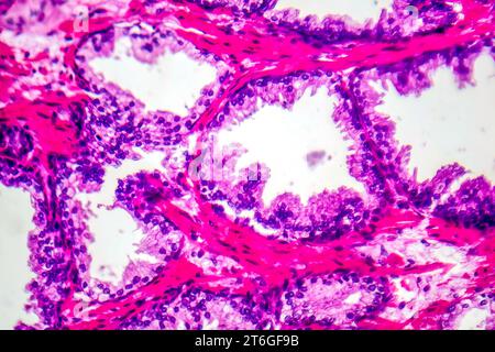 Micrografia dell'iperplasia prostatica, che mostra un aumento del tessuto ghiandolare. Foto Stock