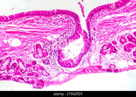 Fotomicrografia della metaplasia squamosa epiteliale bronchiale, che mostra la trasformazione delle cellule squamose nel rivestimento respiratorio. Foto Stock