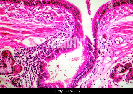 Fotomicrografia della metaplasia squamosa epiteliale bronchiale, che mostra la trasformazione delle cellule squamose nel rivestimento respiratorio. Foto Stock