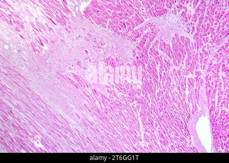 Fotomicrografia di infarto miocardico, mostrando tessuto cardiaco danneggiato a causa di un ridotto afflusso di sangue e morte cellulare. Foto Stock