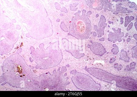 Fotomicrografia del carcinoma basale, che mostra le cellule basali maligne tipiche del cancro cutaneo più comune. Foto Stock