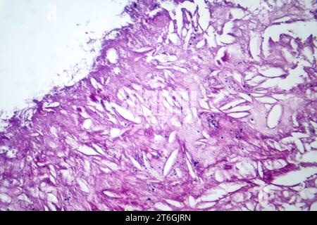 Fotomicrografia del melanoma, che mostra melanociti maligni, le cellule primarie responsabili del cancro cutaneo aggressivo. Foto Stock