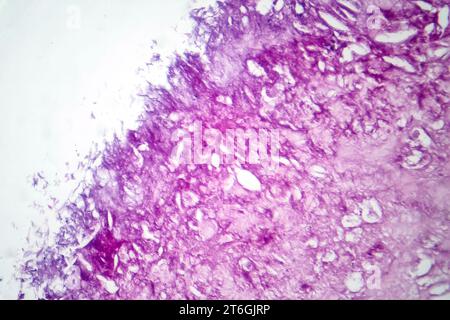 Fotomicrografia del melanoma, che mostra melanociti maligni, le cellule primarie responsabili del cancro cutaneo aggressivo. Foto Stock