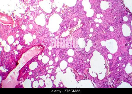 Fotomicrografia della polmonite lobare durante il periodo di edema emorragico, che mostra infiammazione del tessuto polmonare con alterazioni emorragiche. Foto Stock