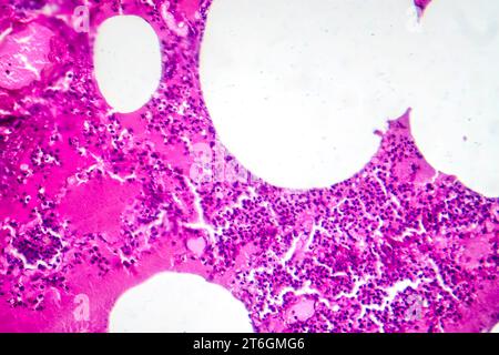 Fotomicrografia della polmonite lobare durante il periodo di edema emorragico, che mostra infiammazione del tessuto polmonare con alterazioni emorragiche. Foto Stock