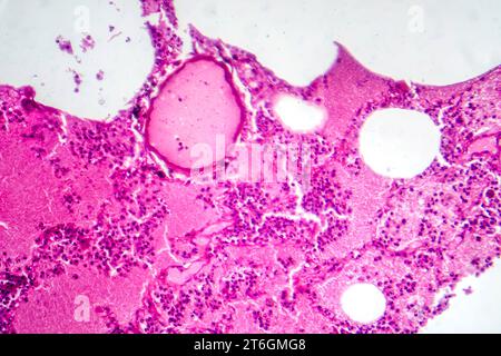 Fotomicrografia della polmonite lobare durante il periodo di edema emorragico, che mostra infiammazione del tessuto polmonare con alterazioni emorragiche. Foto Stock