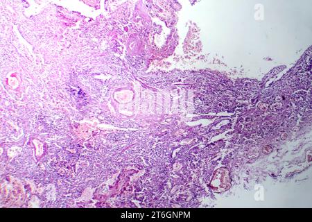 Fotomicrografia della polmonite virale, rivelando infiammazione e danno cellulare causato da un'infezione respiratoria virale. Foto Stock