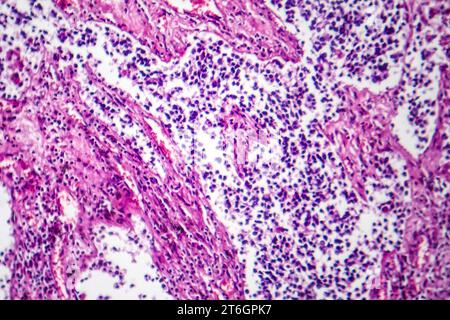 Fotomicrografia del cancro del polmone a piccole cellule, che rivela cellule maligne dense e ricche caratteristiche di una neoplasia polmonare aggressiva. Foto Stock