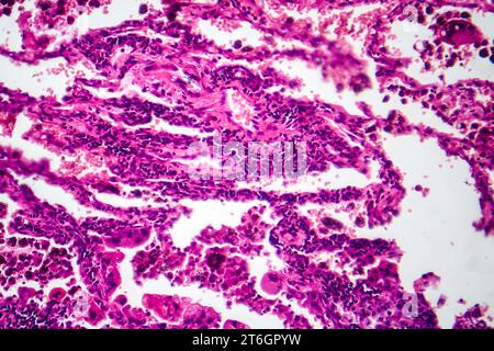 Fotomicrografia del tessuto tumorale polmonare, che rivela le cellule maligne e la caratteristica di crescita anomala della neoplasia polmonare. Foto Stock