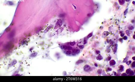 Osteoclasti nel midollo osseo rosso umano. L'osteoclasto è una cellula multinucleata. Colorazione con ematossilina ed eosina. Ingrandimento - 1000. Foto Stock