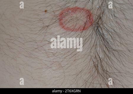 Primo piano dettagliato di infezione fungina tigna (tinea) sulla pelle umana – immagine ad alta risoluzione che raffigura il distintivo rosso, eruzione circolare e scalare comune alla dermatofitosi; utile per medico, Dermatologia, e salute scopi di educazione per illustrare condizioni della pelle, sintomi, cause, prevenzione, e opzioni di trattamento per la tigna e altre infezioni fungine. Foto Stock