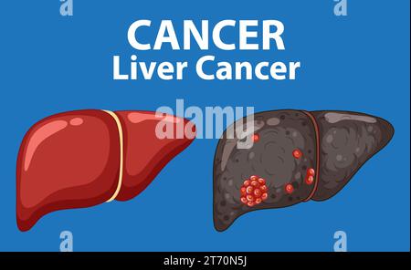 Infografica che illustra le differenze tra cellule epatiche sane e cancerose Illustrazione Vettoriale