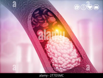 Aterosclerosi, placca di colesterolo nell'arteria. illustrazione 3d. Foto Stock