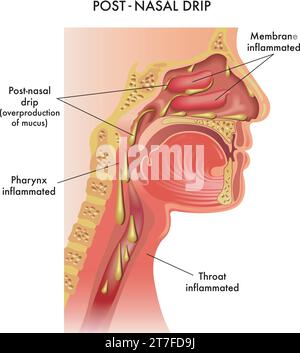 Illustrazione medica dei sintomi di gocciolamento post-nasale, con annotazioni. Illustrazione Vettoriale