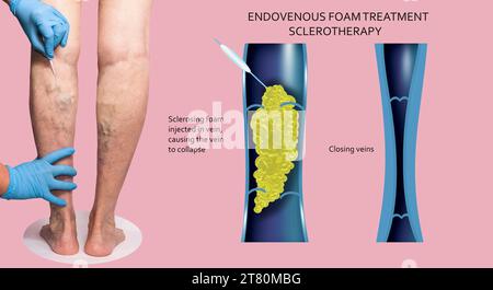 Trattamento laser endovenoso per vene varicose - concetto di scleroterapia della schiuma. Prima e dopo. Struttura venosa Foto Stock