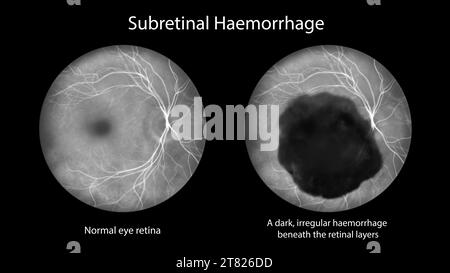 Emorragia subretinica sulla retina, illustrazione Foto Stock