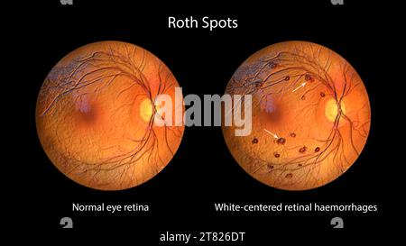 Illustrazione di macchie di Roth nella retina osservata durante l'oftalmoscopia. Vi sono emorragie retiniche centrate in bianco con anelli emorragici circostanti. Foto Stock