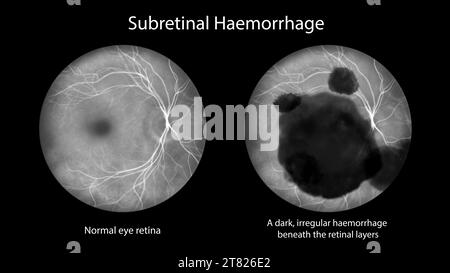 Emorragia subretinica sulla retina, illustrazione Foto Stock