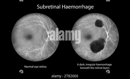 Emorragia subretinica sulla retina, illustrazione Foto Stock